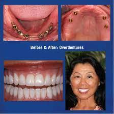 Implant Supported Over-Dentures Wellington FL | Hybrid Over Denture